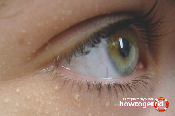 Comment se débarrasser du wen sous les yeux