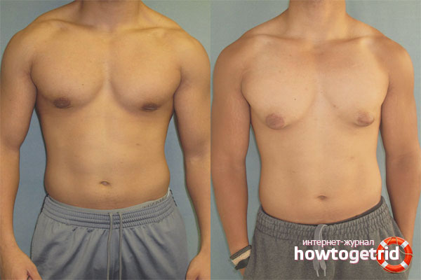 Traitement de la gynécomastie