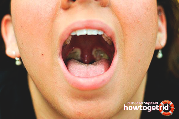 Comment éliminer le pus des amygdales