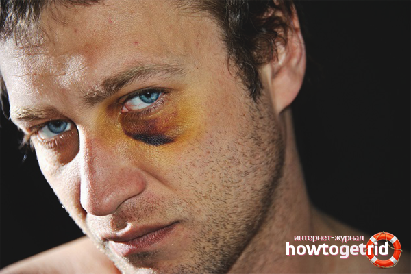 Comment guérir rapidement un œil au beurre noir