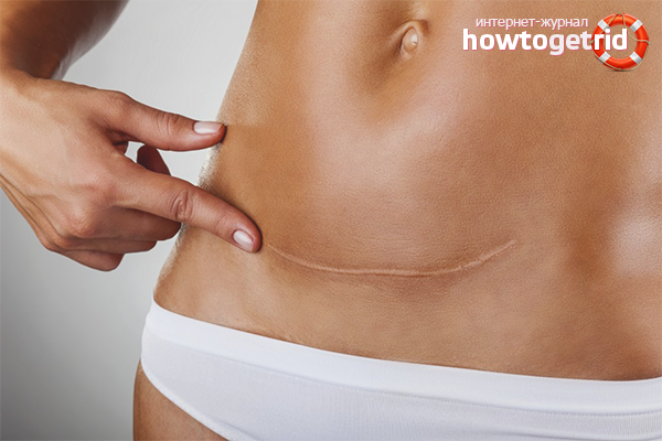 Comment se débarrasser d'une cicatrice après une intervention chirurgicale