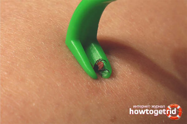 Comment tirer une tique avec des pincettes