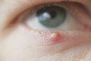 Comment traiter l'orge dans les yeux