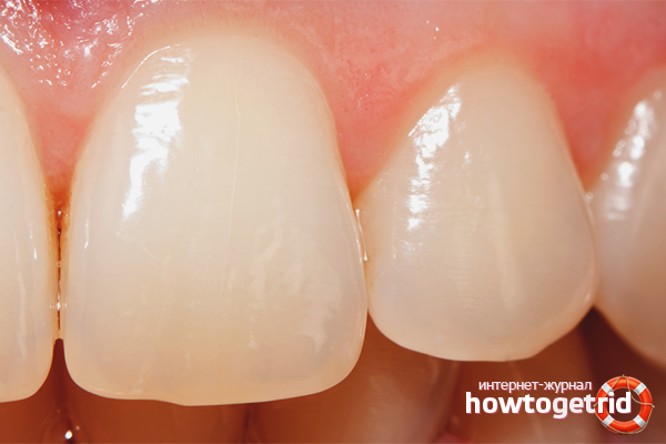 Comment restaurer l'émail des dents