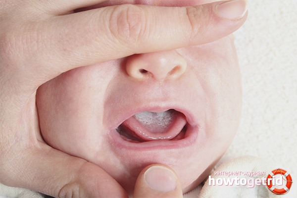 Comment reconnaître la candidose