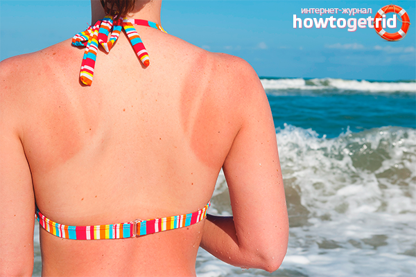 Que faire en cas de coups de soleil importants