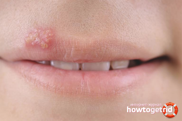 Comment guérir rapidement un rhume sur la lèvre