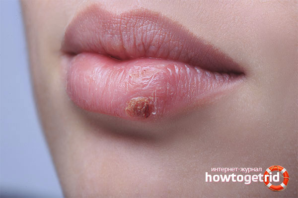 Froid sur les lèvres