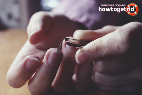 Comment tirer un éclat sous l'ongle