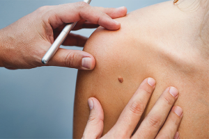 Comment se débarrasser des taupes