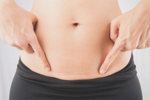 Comment gérer une suture après une césarienne