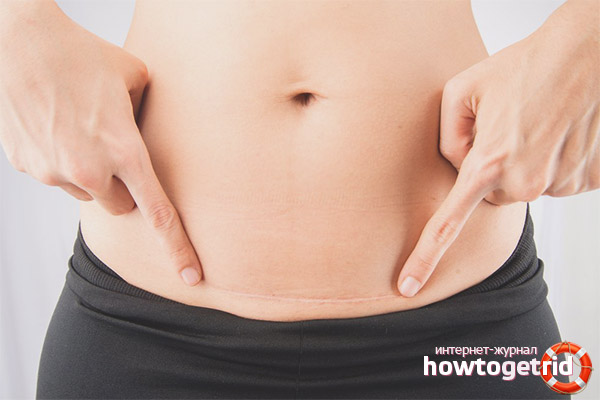 Comment gérer une suture après une césarienne