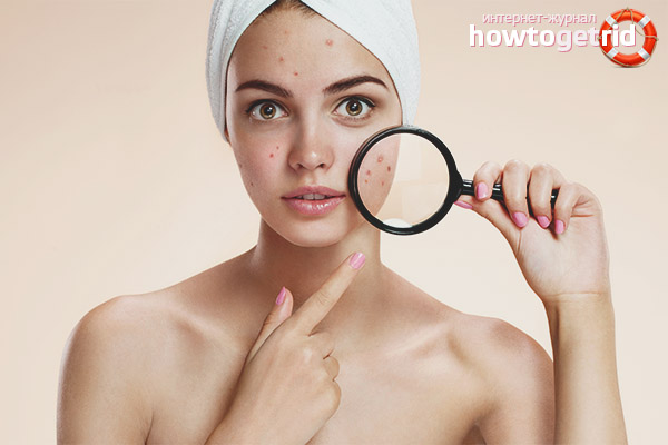 Acné sur le visage pendant la grossesse