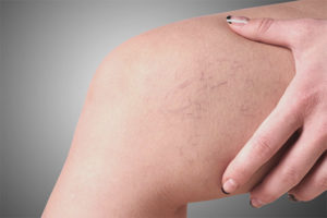 Veines d'araignée sur les jambes