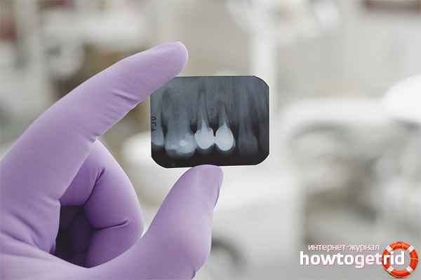 Est-il possible de faire une radiographie des dents pendant la grossesse?