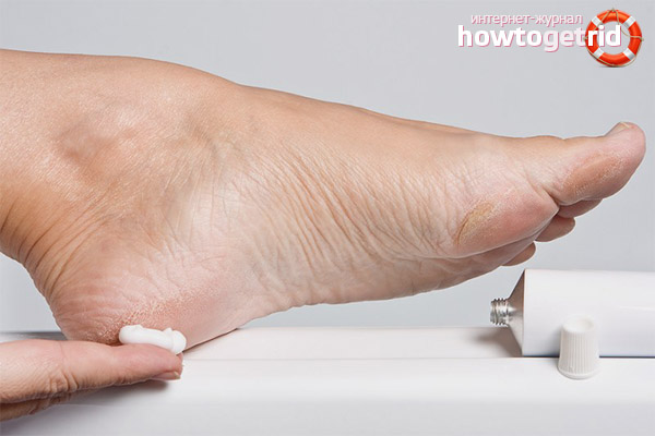 Remèdes en pharmacie pour les talons fendillés